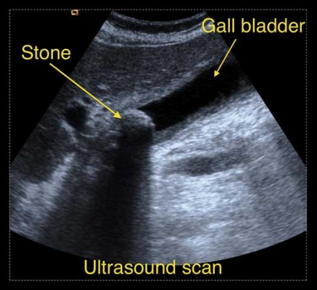 Gallstone ultrasound scan