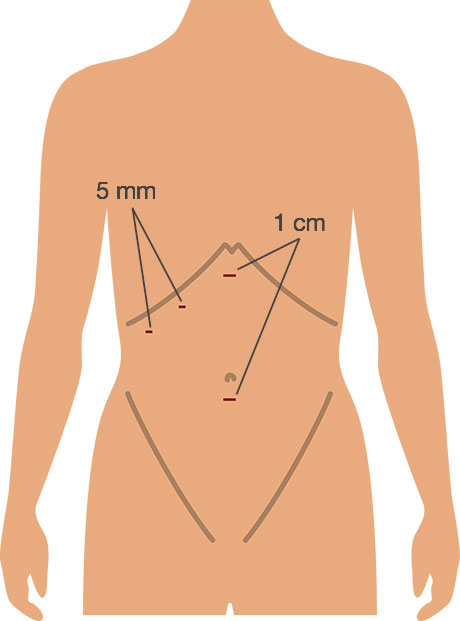 Picture showing incisions for lap cholecystectomy